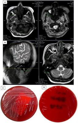 Analysis of a case report of meningitis caused by Listeria monocytogenes